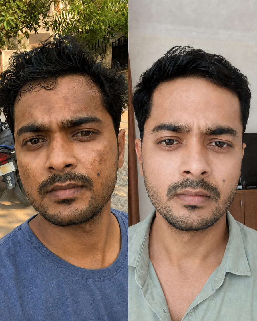 Pigmentation and tanning gone!
